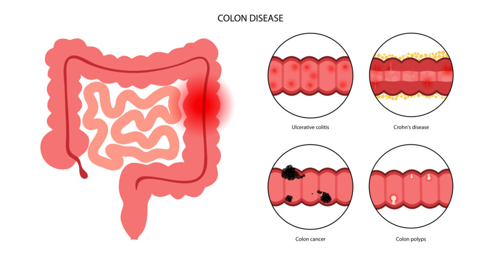 Colon Disease Infographic