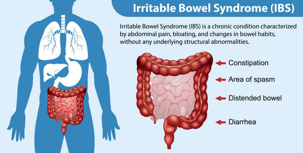 Irritable Bowel Syndrome (IBS) Infographic Illustration