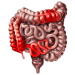 Role of Genetics in Gastrointestinal Diseases