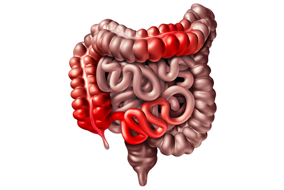 Role of Genetics in Gastrointestinal Diseases