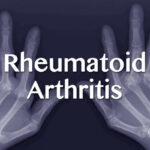 Rheumatoid Arthritis (RA)