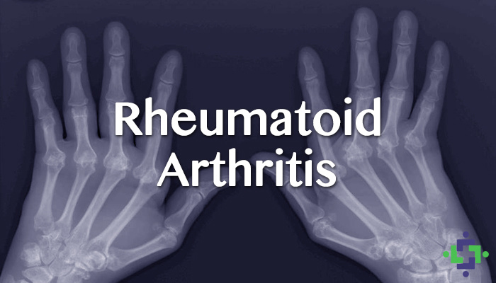 Rheumatoid Arthritis (RA)